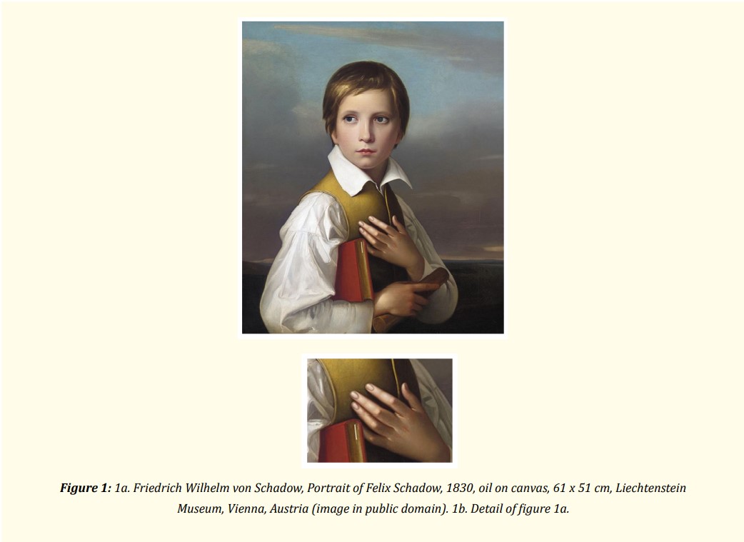 Portrait of Felix Schadow, a portrait by Friedrich Wilhelm von Schadow is an example of a 19th century Biedermeier style painting that depicts juvenile arthritis