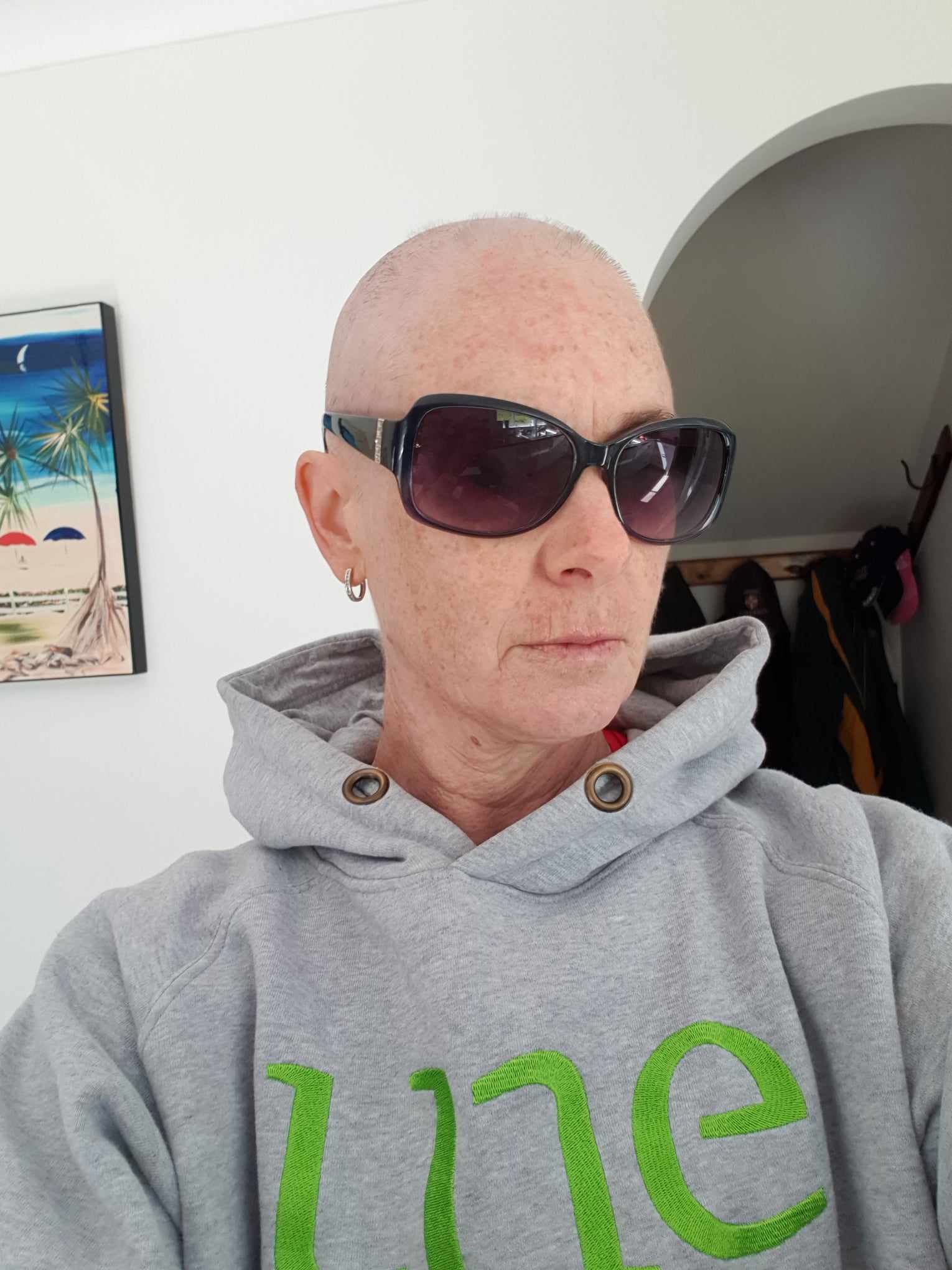 Melissa had long hair before chemo but then rocked a bald head.
